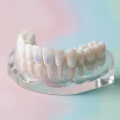 Implants dentaires : Signes clés à Rabat | Bô Sourire