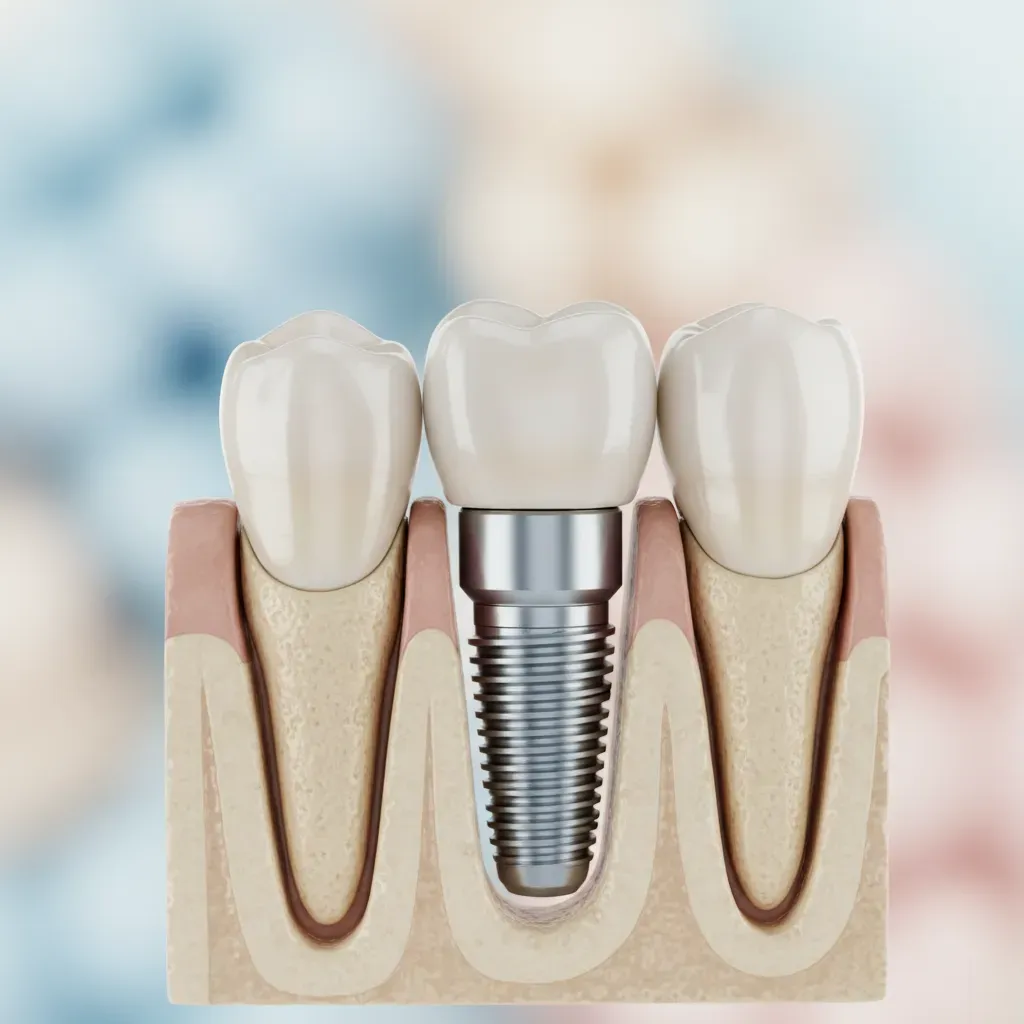 Implants Dentaires Rabat : Retrouvez le Sourire | Bô Sourire