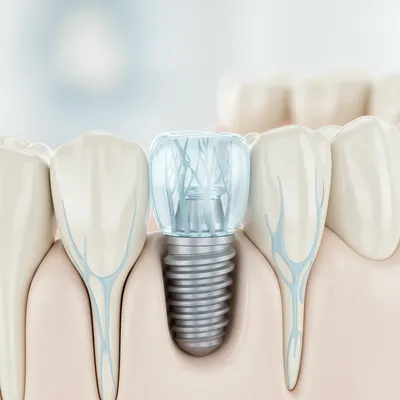 Implants dentaires après extraction dents de sagesse - Bô Sourire